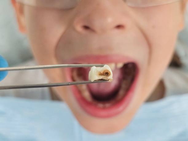Best Broken or Cracked Tooth Emergency Dentist in Kendall West, FL